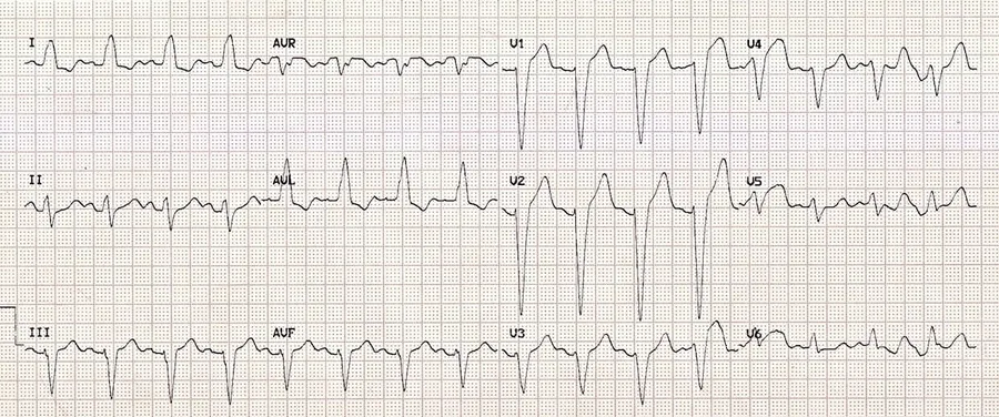 Traçado de ECG para identificar