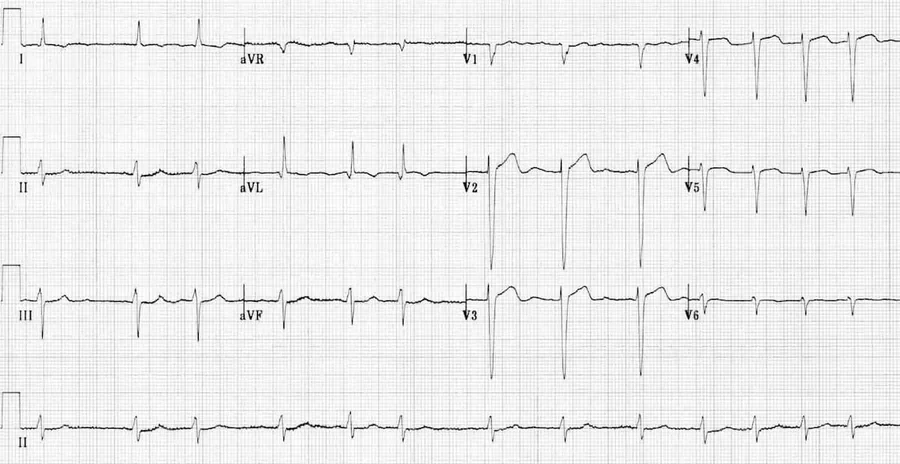 Traçado de ECG para identificar