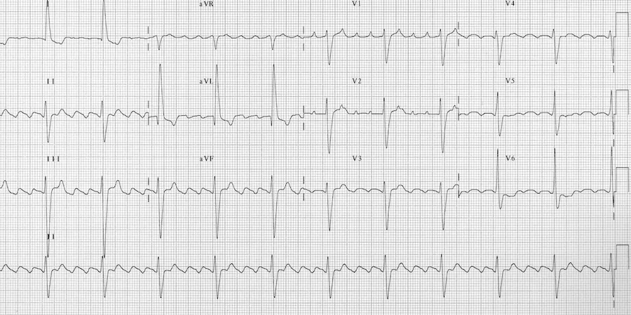 Traçado de ECG para identificar