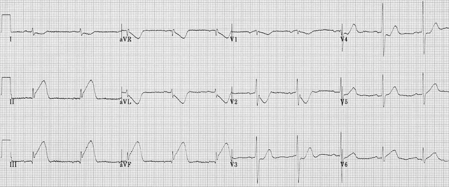 Traçado de ECG para identificar