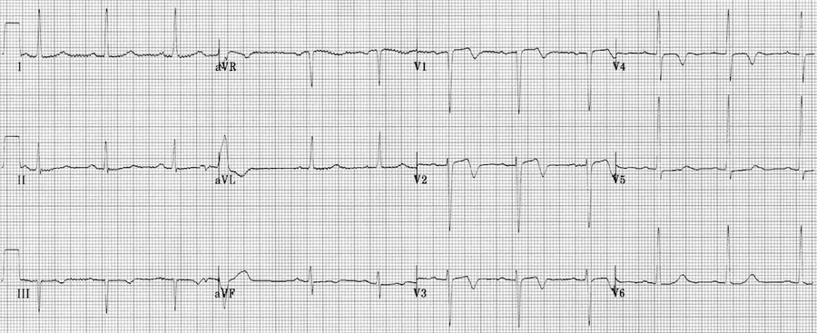 Traçado de ECG para identificar